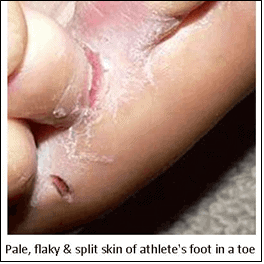 Athlete’s Foot
